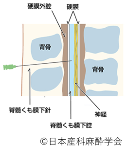 脊髄くも膜下麻酔